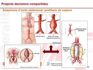 16
Projecte decisions compartides
16
Aneurisma d’aorta abdominal: profilaxis de ruptura
 