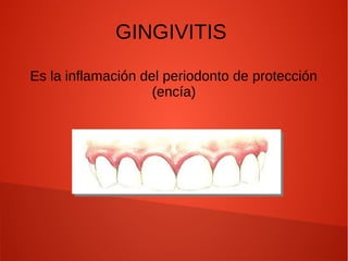 GINGIVITIS
Es la inflamación del periodonto de protección
(encía)
 