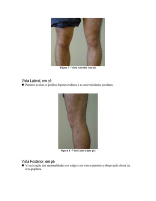 Figura 3 - Vista Anterior (em pé)




Vista Lateral, em pé
  Permite avaliar os joelhos hiperestendidos e as anormalidades patelares.




                              Figura 4 - Vista Lateral (em pé)



Vista Posterior, em pé
  Visualização das anormalidades em valgo e em varo e permite a observação direta da
  área poplítea.
 