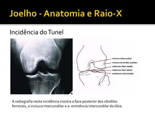 Incidência doTunel
A radiografia nesta incidência mostra a face posterior dos côndilos
femorais, a incisura intercondilar e a· eminência intercondilar da tíbia.
 
