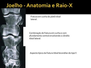 Fratura em cunha do platô tibial
lateral.
Combinação de fratura em cunha e com
afundamento central envolvendo o côndilo
tibial lateral.
Aspecto típico da fratura tibial bicondilar do tipoY.
 