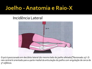 Incidência Lateral
O pct é posicionado em decúbito lateral (do mesmo lado do joelho afetado), flexionado 25º. O
raio central é orientado para a parte medial da articulação do joelho com angulação de cerca de
5º cefálicos.
 