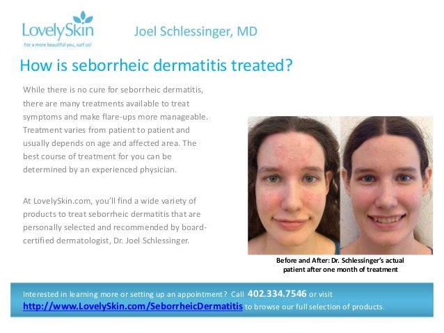 How do you treat seborrhea?
