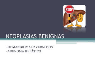 NEOPLASIAS BENIGNAS 
-HEMANGIOMA CAVERNOSOS 
-ADENOMA HEPÁTICO 
 