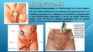 Histerectomía robótica: este procedimiento es
similar a la cirugía laparoscópica, pero se utiliza
una máquina especial (ro...