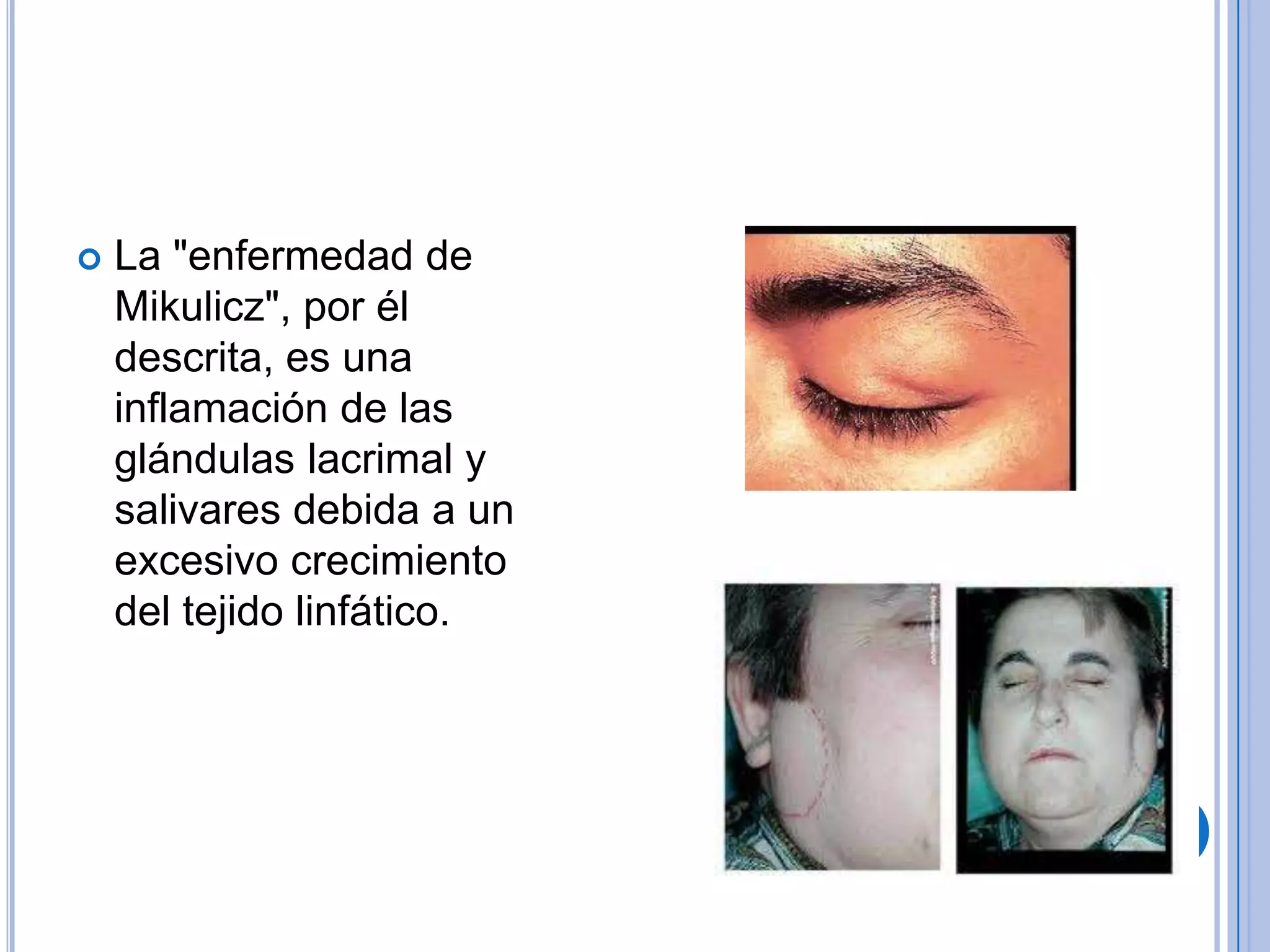 Johann von Mikulicz Radecki