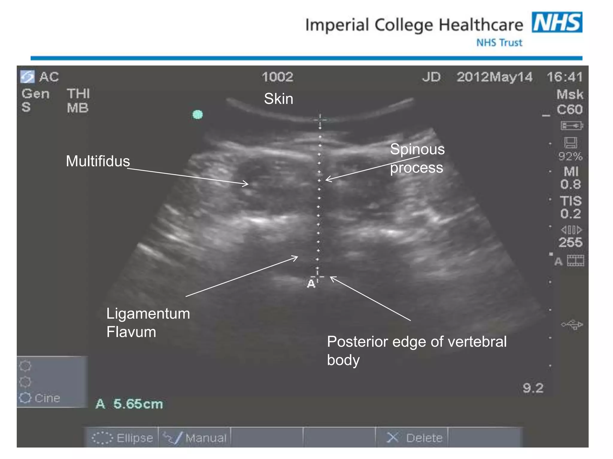 Skin
Insert slide title here
                                    Spinous
 Multifidus                         process




       Ligamentum
       Flavum
                           Posterior edge of vertebral
                           body
 