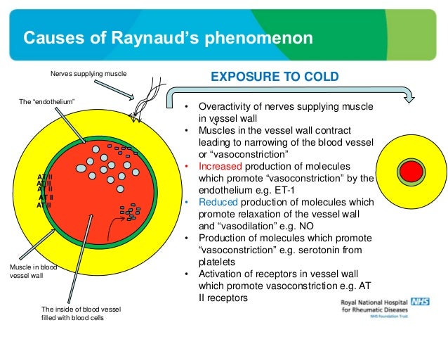 Raynaud's phenomenon - NHS Choices