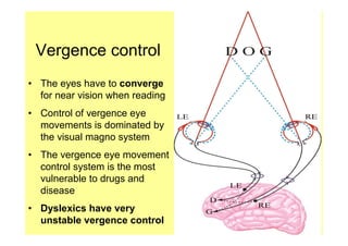 Vergence control
• The eyes have to converge
  for near vision when reading
• Control of vergence eye
  movements is dominated by
  the visual magno system
• The vergence eye movement
  control system is the most
  vulnerable to drugs and
  disease
• Dyslexics have very
  unstable vergence control
 