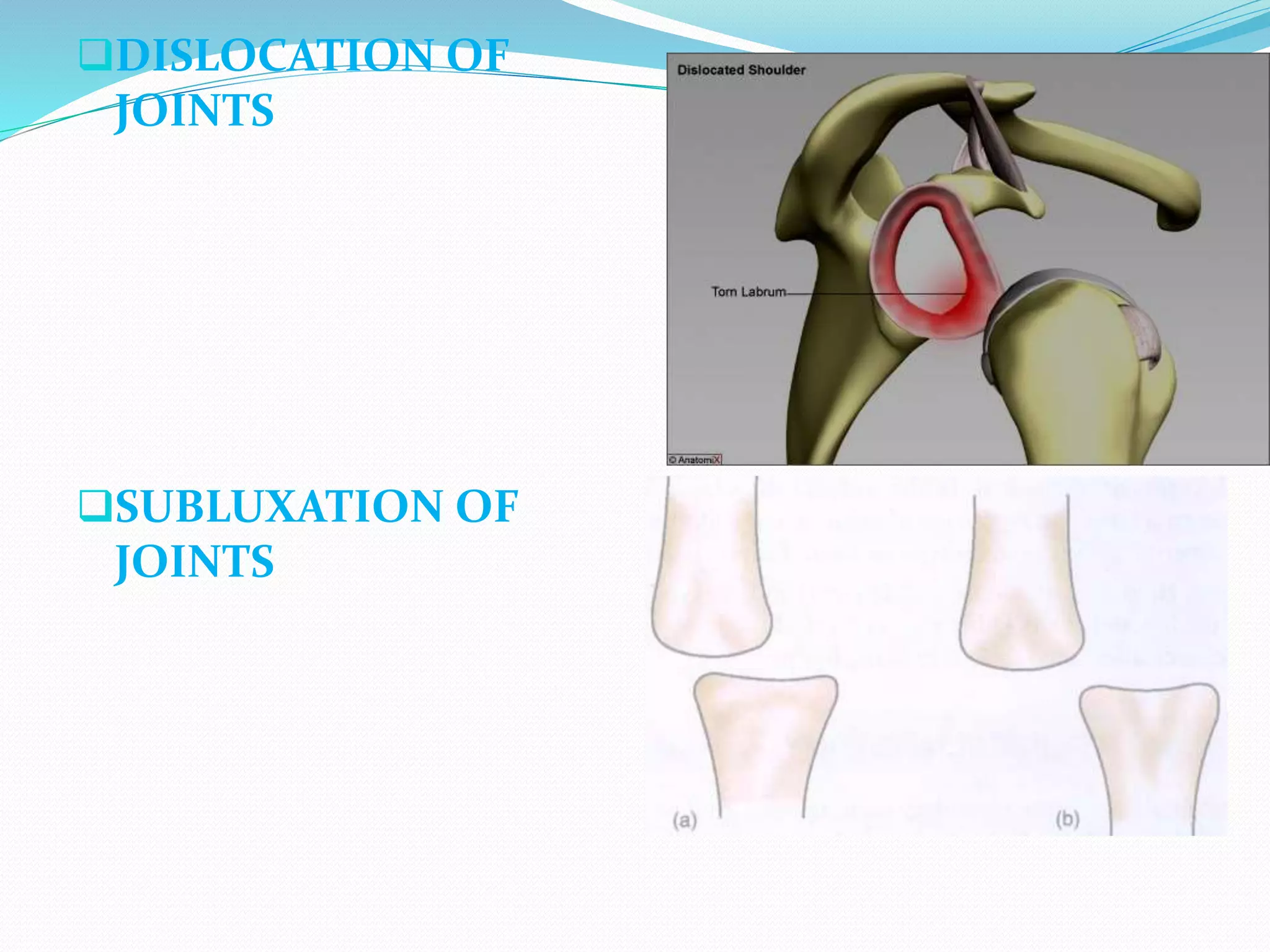 DISLOCATION OF
JOINTS
SUBLUXATION OF
JOINTS
 