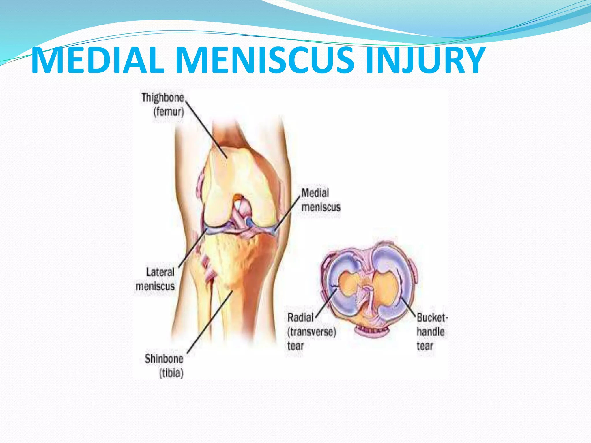 MEDIAL MENISCUS INJURY
 