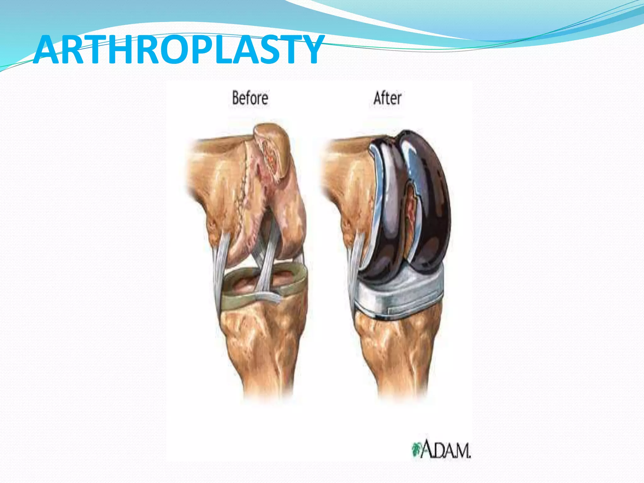 ARTHROPLASTY
 