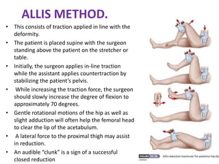 JOINT DISLOCATION of hip knee and shoulder PART-2.pptx