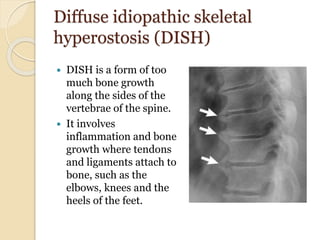 Diffuse idiopathic skeletal
hyperostosis (DISH)
 DISH is a form of too
much bone growth
along the sides of the
vertebrae of the spine.
 It involves
inflammation and bone
growth where tendons
and ligaments attach to
bone, such as the
elbows, knees and the
heels of the feet.
 