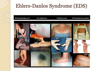 Ehlers-Danlos Syndrome (EDS)
 
