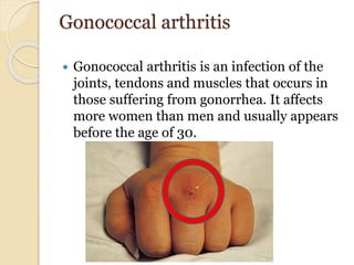 Gonococcal arthritis
 Gonococcal arthritis is an infection of the
joints, tendons and muscles that occurs in
those suffering from gonorrhea. It affects
more women than men and usually appears
before the age of 30.
 