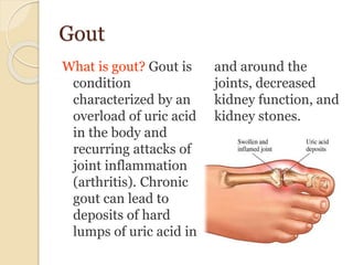 Gout
What is gout? Gout is
condition
characterized by an
overload of uric acid
in the body and
recurring attacks of
joint inflammation
(arthritis). Chronic
gout can lead to
deposits of hard
lumps of uric acid in
and around the
joints, decreased
kidney function, and
kidney stones.
 