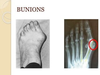 BUNIONS
 