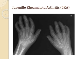 Juvenille Rheumatoid Arthritis (JRA)
 