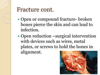 Fracture cont.
 Open or compound fracture- broken
bones pierce the skin and can lead to
infection.
 Open reduction –surgical intervention
with devices such as wires, metal
plates, or screws to hold the bones in
alignment.
 
