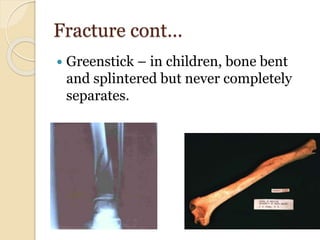 Fracture cont…
 Greenstick – in children, bone bent
and splintered but never completely
separates.
 