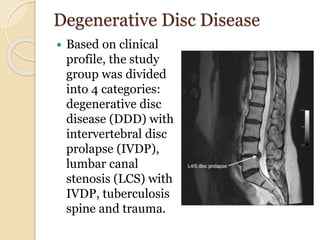 Degenerative Disc Disease
 Based on clinical
profile, the study
group was divided
into 4 categories:
degenerative disc
disease (DDD) with
intervertebral disc
prolapse (IVDP),
lumbar canal
stenosis (LCS) with
IVDP, tuberculosis
spine and trauma.
 