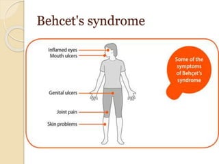 Behcet's syndrome
 