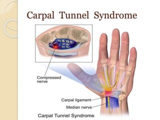 Carpal Tunnel Syndrome
 