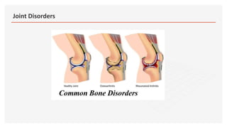 Joint Disorders
 