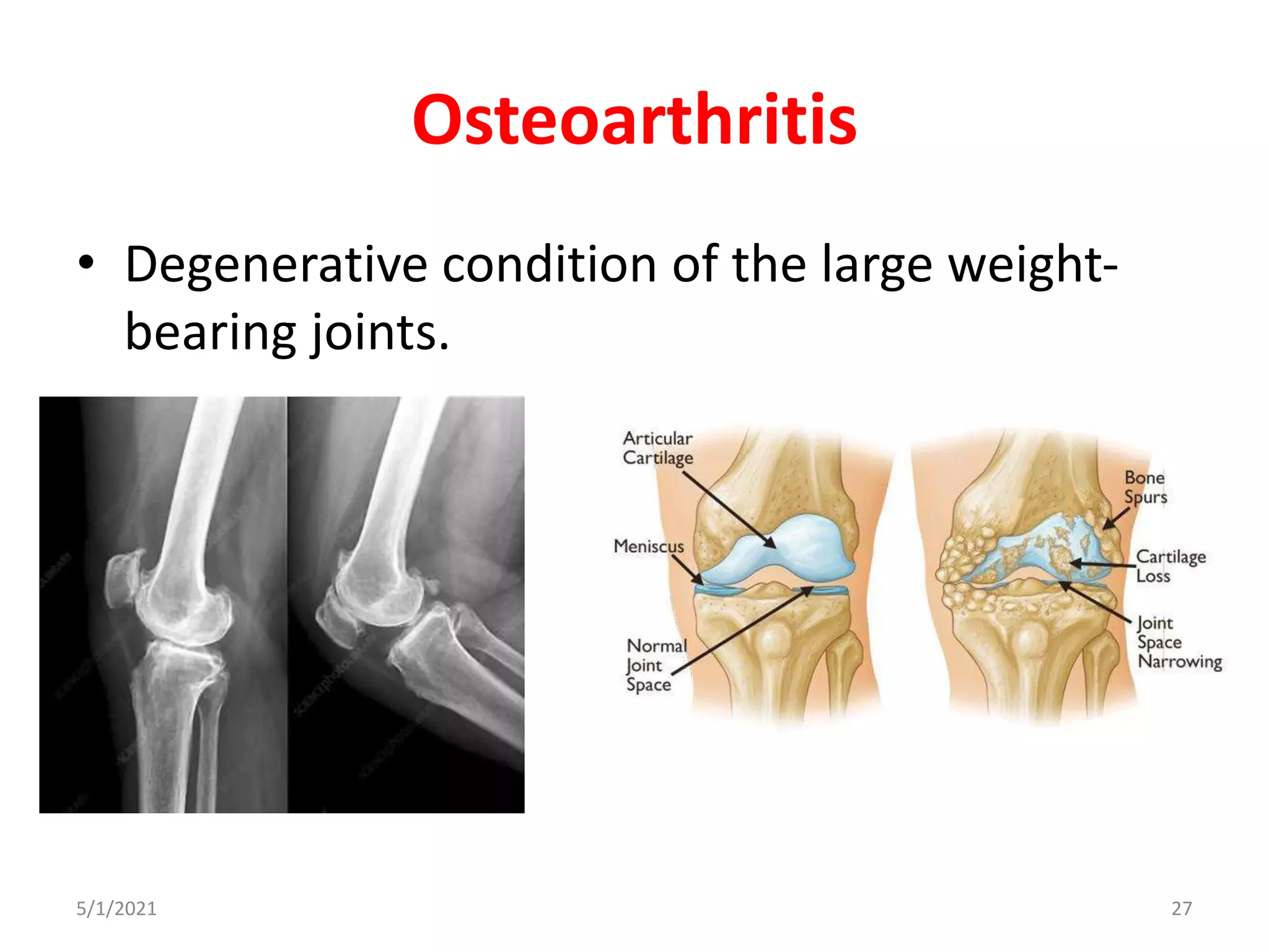 Osteoarthritis
• Degenerative condition of the large weight-
bearing joints.
5/1/2021 27
 