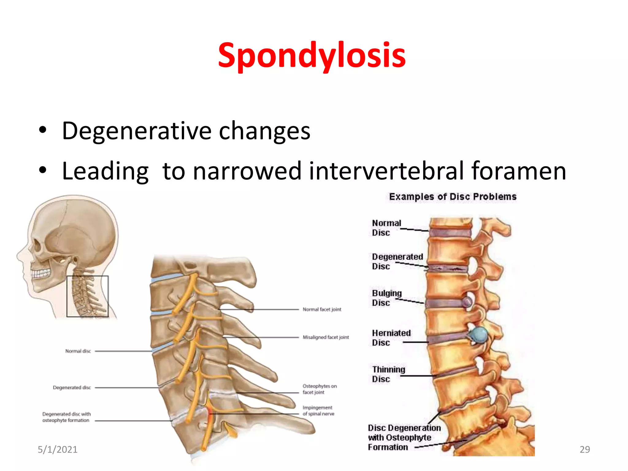 Spondylosis
• Degenerative changes
• Leading to narrowed intervertebral foramen
5/1/2021 29
 
