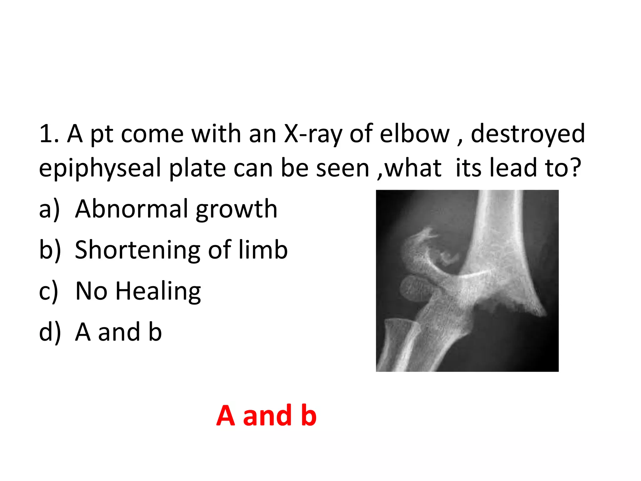 1. A pt come with an X-ray of elbow , destroyed
epiphyseal plate can be seen ,what its lead to?
a) Abnormal growth
b) Shortening of limb
c) No Healing
d) A and b
A and b
 