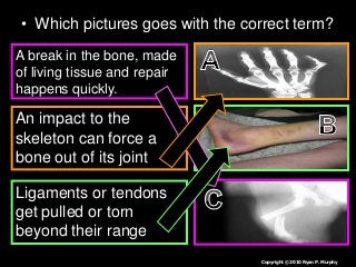 • Which pictures goes with the correct term?
A break in the bone, made
of living tissue and repair
happens quickly.
An impact to the
skeleton can force a
bone out of its joint
Ligaments or tendons
get pulled or torn
beyond their range
Copyright © 2010 Ryan P. Murphy
 