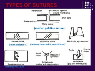 TYPES OF SUTURES
(median palatine suture)
(inter parietal s.)
(lambdoid suture)
(between temporal & parietal bone)
 