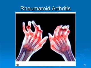Rheumatoid Arthritis
75
 
