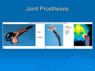 Joint Prostheses
77
 