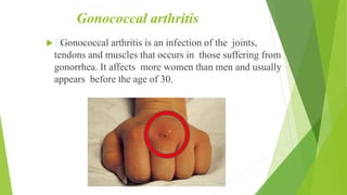 JOINTS CLASSIFICATION AND DISORDERS.pptx