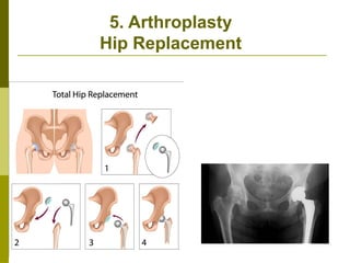 Hip Transposition joints general anatomy of human body and | PPTX