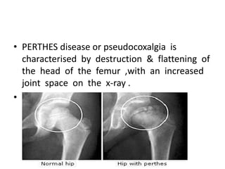 • PERTHES disease or pseudocoxalgia is
characterised by destruction & flattening of
the head of the femur ,with an increased
joint space on the x-ray .
• .
 