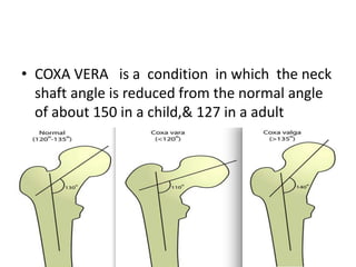• COXA VERA is a condition in which the neck
shaft angle is reduced from the normal angle
of about 150 in a child,& 127 in a adult
 