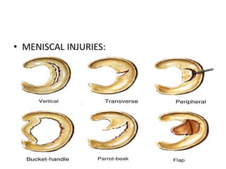 • MENISCAL INJURIES:
 