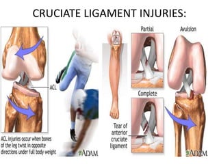 CRUCIATE LIGAMENT INJURIES:
 
