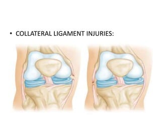 • COLLATERAL LIGAMENT INJURIES:
 