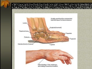 FRACTURE OF SCAPHOID
 