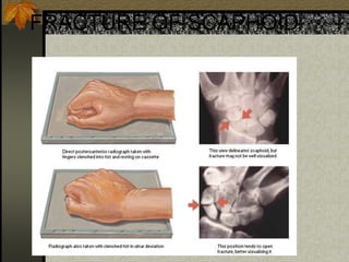 FRACTURE OF SCAPHOID
 