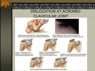 DISLOCATION AT ACROMIO-
CLAVICULAR JOINT
 