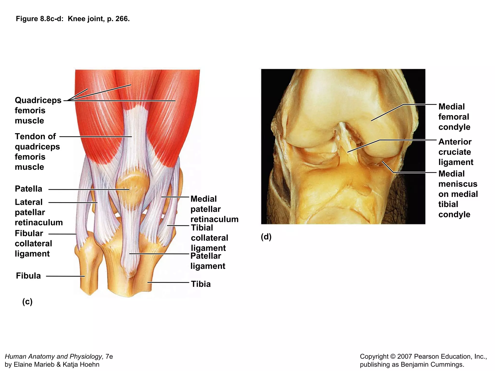 Figure 8.8c-d:  Knee joint, p. 266. (c) (d) Quadriceps femoris muscle Tendon of quadriceps femoris muscle Patella Lateral patellar retinaculum Medial patellar retinaculum Tibial collateral ligament Tibia Fibular collateral ligament Fibula Patellar ligament Medial femoral condyle Anterior cruciate ligament Medial meniscus on medial tibial condyle 