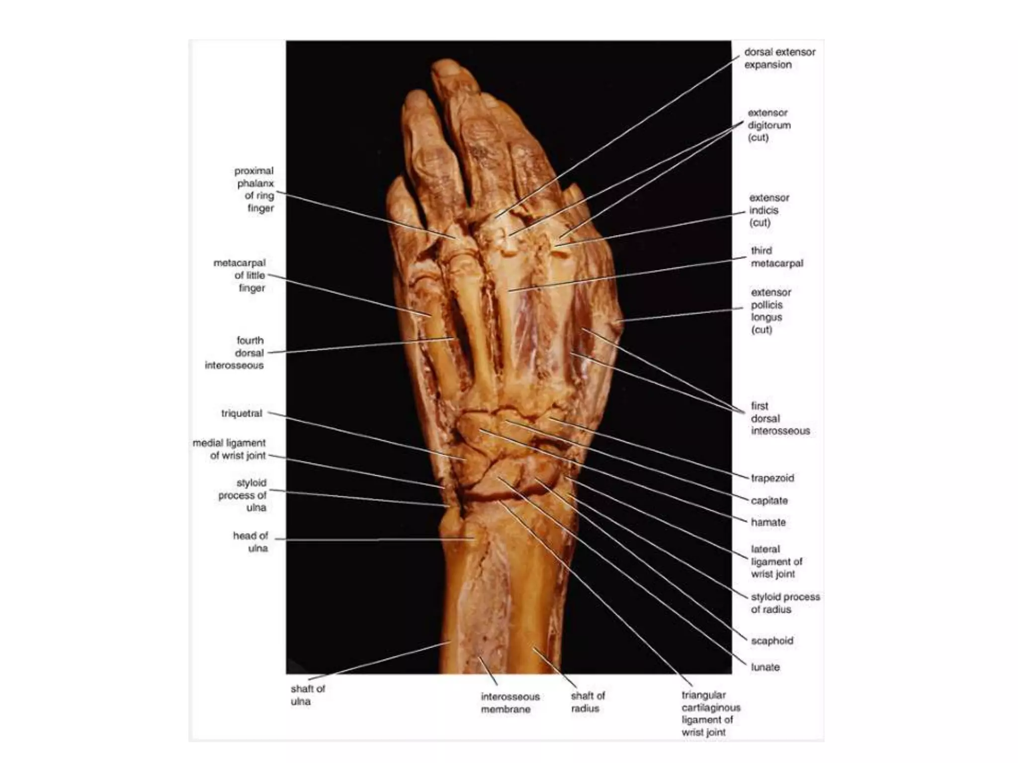 Wrist Joint (Radiocarpal Joint)Articulation: Between the distal end of the radius and the articular disc above and the scaphoid, lunate, and triquetral bones below.Type: Synovial ellipsoid jointCapsule: The capsule encloses the joint and is attached above to the distal ends of the radius and ulna and below to the proximal row of carpal bones.Ligaments: Anterior and posterior ligaments strengthen the capsule. The medial ligament is attached to the styloid process of the ulna and to the triquetral bone.The lateral ligament is attached to the styloid process of the radius and to the scaphoid bone.Synovial membrane: This lines the capsule and is attached to the margins of the articular surfaces. The joint cavity does not communicate with that of the distal radioulnar joint or with the joint cavities of the intercarpal joints.Nerve supply: Anterior interosseous nerve and the deep branch of the radial nerve.