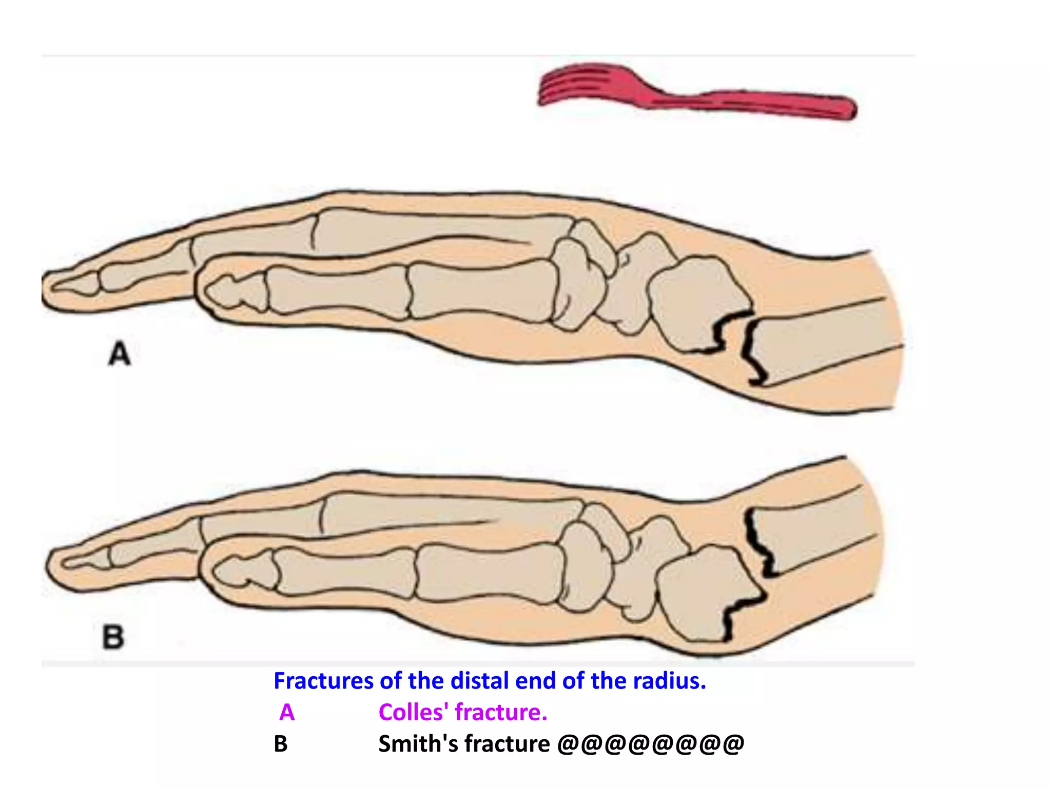 Clinical NotesWrist Joint InjuriesBecause the styloid process of the radius is longer than that of the ulna, abduction of the wrist joint is less extensive than adduction. In flexion extension movements, the hand can be flexed about 80° but extended to only about 45°. The range of flexion is increased by movement at the midcarpal joint.A fall on the outstretched hand can strain the anterior ligament of the wrist joint, producing synovial effusion, joint pain, and limitation of movement. These symptoms and signs must not be confused with those produced by a fractured scaphoid or dislocation of the lunate bone, which are similar.Falls on the Outstretched HandIn falls on the outstretched hand, forces are transmitted from the scaphoid to the distal end of the radius, from the radius across the interosseous membrane to the ulna, and from the ulna to the humerus; thence, through the glenoid fossa of the scapula to the coracoclavicular ligament and the clavicle; and finally, to the sternum.If the forces are excessive, different parts of the upper limb give way under the strain. The area affected seems to be related to age. In a young child, for example, there may be a posterior displacement of the distal radial epiphysis; in the teenager the clavicle might fracture; in the young adult the scaphoid is commonly fractured; and in the elderly the distal end of the radius is fractured about 1 in. (2.5 cm) proximal to the wrist joint (Colles' fracture).@@@@