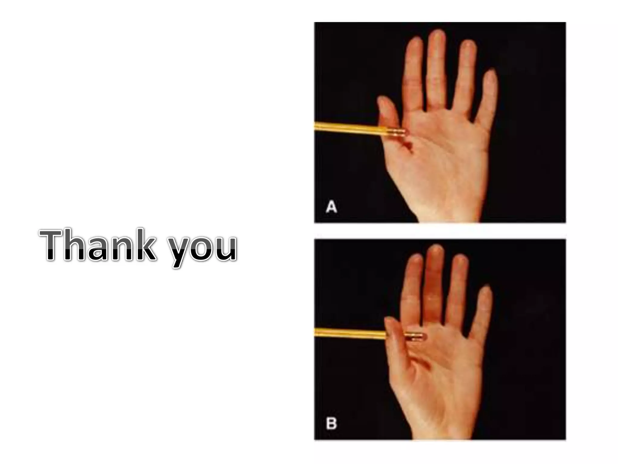 Making a Fist(Try to make a strong fist with the wrist joint flexed, it is very difficult.) Making a fist is accomplished by flexing the metacarpophalangeal joints and the interphalangeal joints of the fingers and thumb. It is performed by the contraction of the long flexor muscles of the fingers and thumb. For this movement to be carried out efficiently a synergic contraction of the extensor carpi radialis longus and brevis and the extensor carpi ulnaris muscles must occur to extend the wrist joint. 